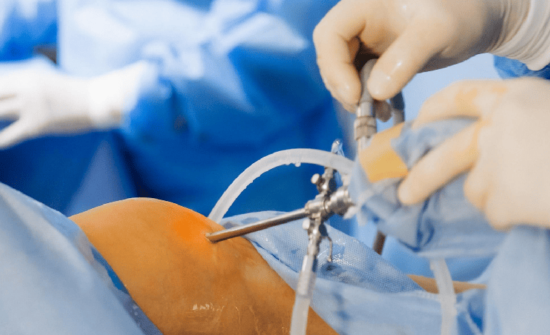 Reconstrucción de lesiones de meniscos por artroscopia