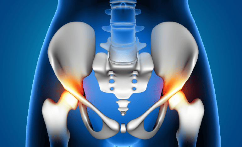 Procedimiento de Remplazo total de cadera en Cuernavaca e Iguala para Traumatología Y Ortopedia